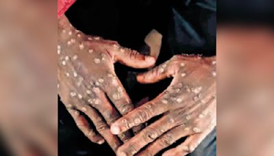 Updated guidelines to be released to prevent Mpox in Kerala: Minister Veena George