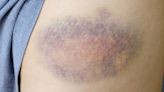 Doctor Shares Red Flag Signs Your Bruise Is Something More Serious