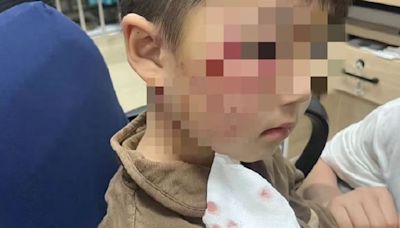 3歲男童遭大型犬攻擊 注射狂犬病疫苗仍發病「嘔吐+情緒狂躁」18天不治