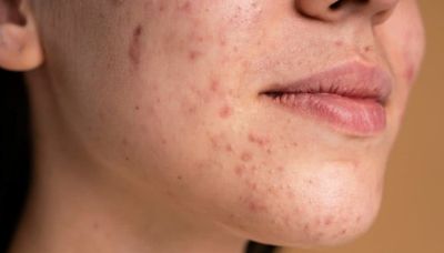 Bebês, jovens e adultos: entenda sobre acne em diferentes fases da vida