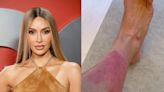 Kim Kardashian shares close-up look at ‘painful’ psoriasis flareup