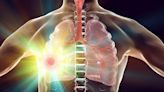 Alecensa approved as first and only anaplastic lymphoma kinase inhibitor for non-small cell lung cancer