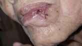 下唇突然長「痣」轉潰瘍 她短短數月由不痛不癢變皮膚癌