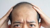 新冠肺炎後遺症還會脫髮，必用Nanogen防脫髮洗頭水急救頭髮稀疏！