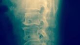 Un dispositivo que rodea la médula espinal podría ayudar a tratar la parálisis