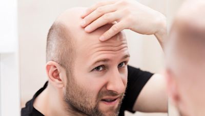 Microneedle Magic: New Alopecia Treatment Can Reverse Hair Loss
