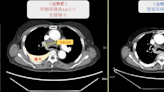 七旬婦肺癌四期 雙免疫療法讓腫瘤幾乎不見