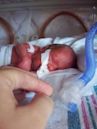 Preterm birth