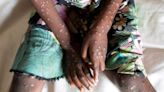 Central African Republic latest to declare mpox outbreak