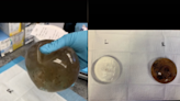 Woman shares photo of ‘mouldy’ breast implant that led to autoimmune disorder