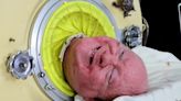 Paul Alexander, Who Lived in an Iron Lung for 70 Years, Dies at 78 After Contracting COVID-19