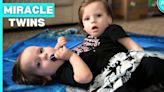 Our Conjoined Twins Were Given 24 Hours To Live | MY EXTRAORDINARY FAMILY