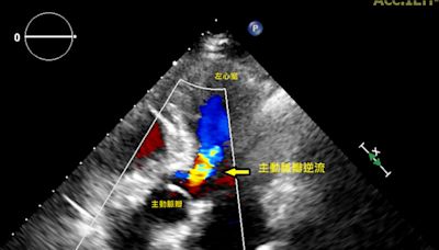 主動脈赫見大腫瘤 瓣膜修補除大患 - 自由健康網