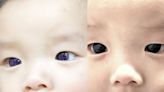 泰6月大男嬰眼睛「一夜變色」 原因竟是新冠特效藥搞怪