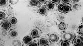 Herpes infections take major economic toll globally, new research shows