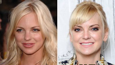 17 Celebs Who Dissolved Or Stop Getting Facial Fillers (And Why)