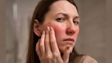 Edema facial: por qué nos despertamos con la cara hinchada y cómo solucionarlo