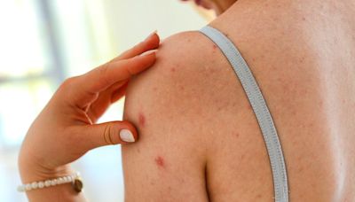 Chickenpox vs. Shingles: Causes, Symptoms, and Treatments