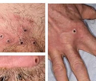 昆州新增10個猴痘病例 均為本地傳染
