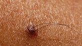 Scientists believe they've discovered a cure for baldness. It's hiding in your hairy moles — and can be injected like Botox.