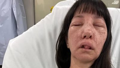 ‘A lot of pain’: Woman survives several brown recluse spider bites