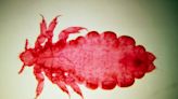 Blood-sucking body lice may have spread plague more than thought, science suggests