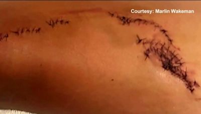 ‘I got really lucky:’ Florida man attacked by 2 sharks shares his story