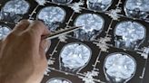 Científicos chilenos hacen uno de los descubrimientos del año: frena el envejecimiento del cerebro