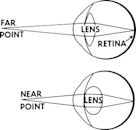 Accommodation (vertebrate eye)