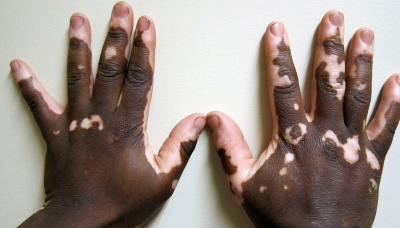 No cure, non-contagious—Dear vitiligo patients, don't be fooled by quacks offering treatment