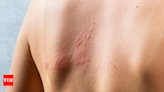 Early symptoms of shingles that you must not ignore - Times of India