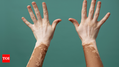 Holistic ways to heal skin disorders like vitiligo and psoriasis | - Times of India