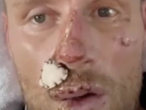 Freddie Flintoff opens up about his injuries in heartbreaking new clip