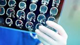 Nuevos estudios muestran cambios cerebrales en personas con COVID prolongado