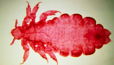 Do body lice spread plague? Science suggests the blood-suckers may have played a surprising role