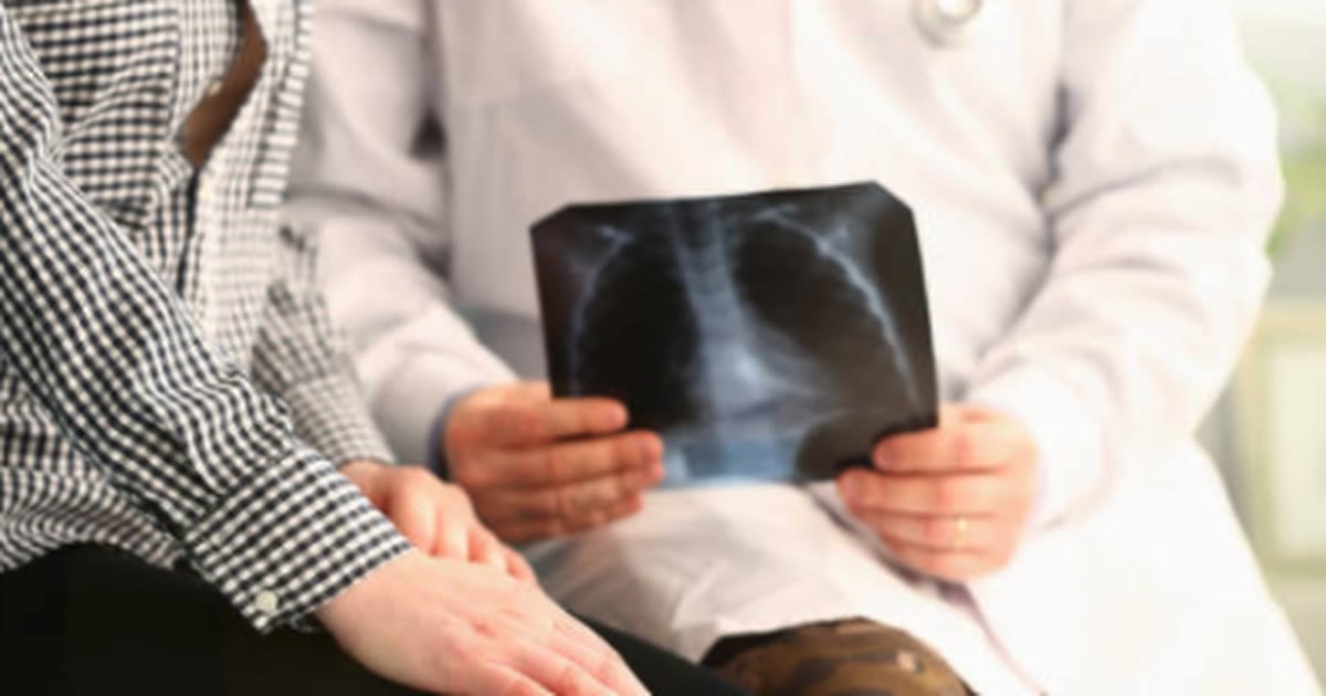 Lung cancer screenings save lives, but most people don’t know about them