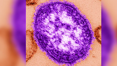 City of Chicago warns of dozens of measles cases, and not all are linked to migrant shelters