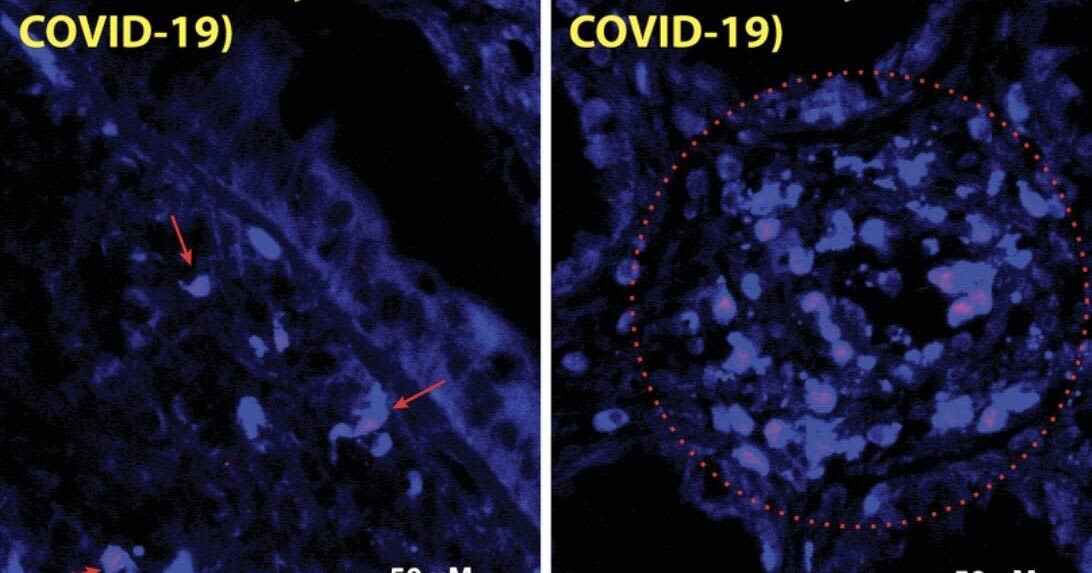 Chronic virus found in long COVID gut up to 2 years post-infection