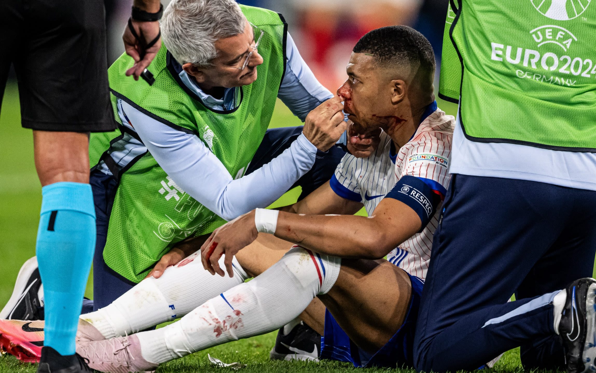 Kylian Mbappe’s Euros in doubt after breaking his nose during narrow France win