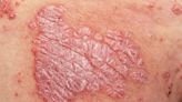 All the Ways Psoriasis Isn't Contagious