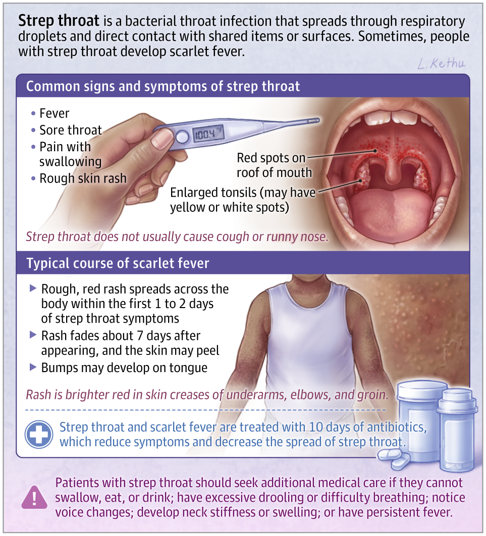 Patient Information: Strep Throat