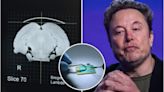 Elon Musk's Neuralink brain chip malfunctions