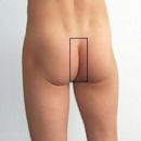 Intergluteal cleft