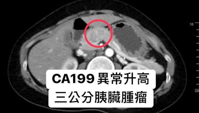 40歲女不菸不酒！照斷層驚見腫瘤「恐罹癌王」 7類人快篩檢