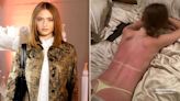 Heidi Klum's Daughter Leni Says She 'Didn't Use Enough Sunscreen' After Brutal Sunburn