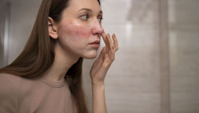 Cuidá tu piel: las 6 cosas que tenés que evitar si sufrís rosácea