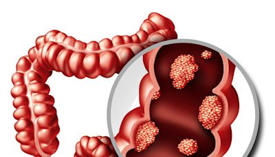 腸癌初期難察覺！醫示警「左右兩側」症狀不同：發現大多已晚期