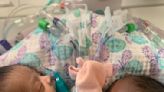 Conjoined twins successfully separated at Texas hospital