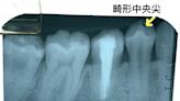 咬起來「怪怪的」 竟是臼齒長「畸形中央尖」恐牙髓壞死