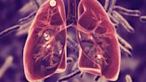 Deadly tuberculosis outbreaks in US linked to tainted bone grafts